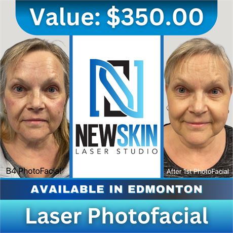 Laser Photofacial