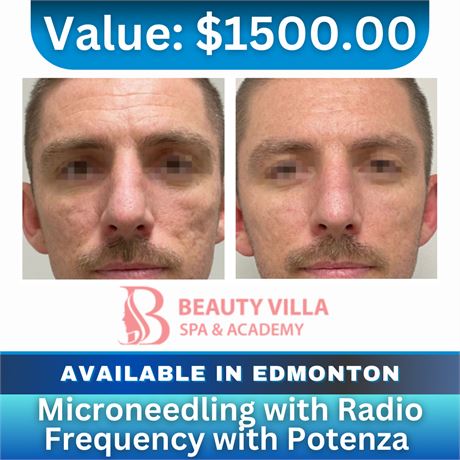 Microneedling with Radio Frequency with potenza