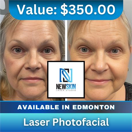 Laser Photofacial