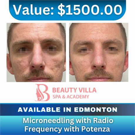 Microneedling with Radio Frequency With Potenza