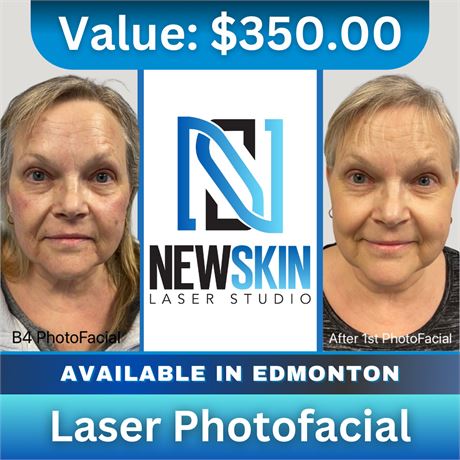 Laser Photofacial