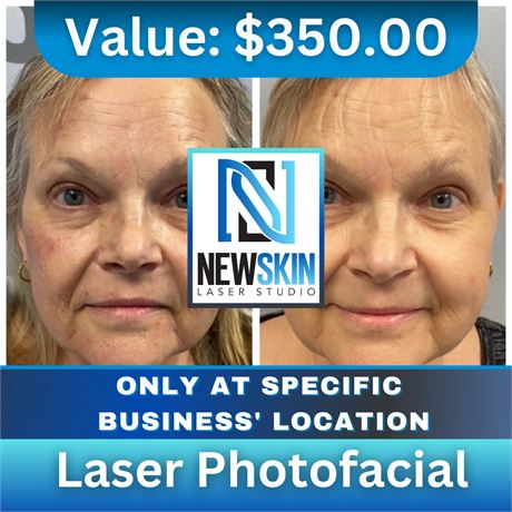 Laser Photofacial